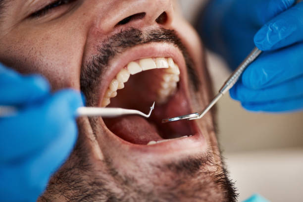 Best Emergency Tooth Extraction in Staic, CA
